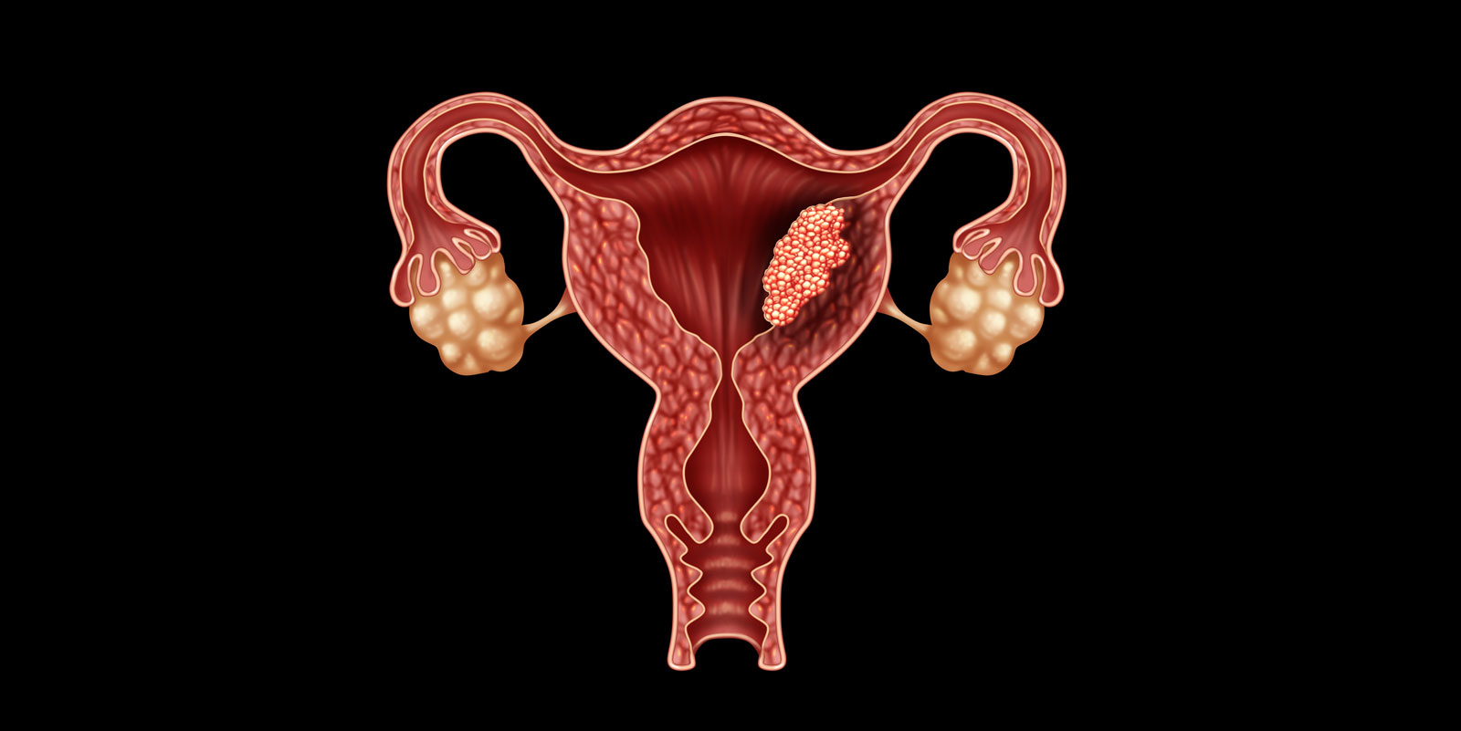 Новообразование эндометрия. Цвет матки 2024. C54.1 злокачественное новообразование эндометрия. Endometrial Cancer Advance.