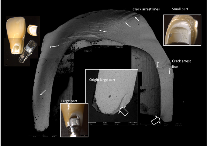 A fractographic map of an implant-based restoration revealing the fracture origin (open white arrow) and the crack propagation through the restoration (white arrows