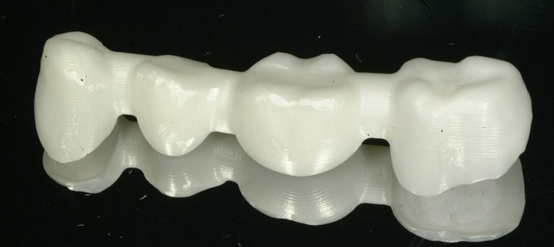 A four-unit zirconia restoration as milled by CAD/CAM