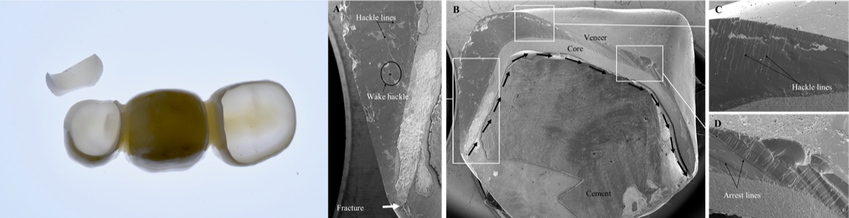 Retrievals of failed restorations can give indications of how and why they failed that can give valuable information regarding how to improve the treatment next time. Fractures specimens can be analyzed by fractography to elucidate the cause of fracture