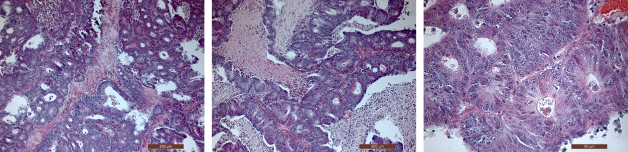 Microscopy pictures of colorectal cancer