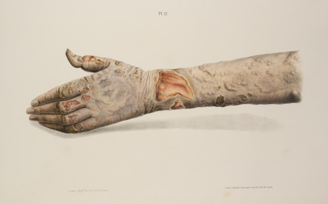 Lepra illustrasjon hånd