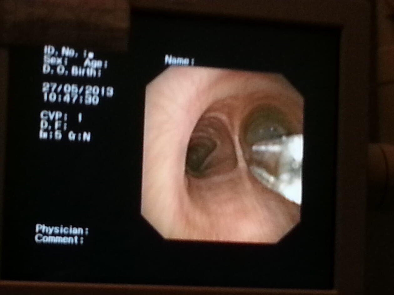 Soppmiljø i lungene