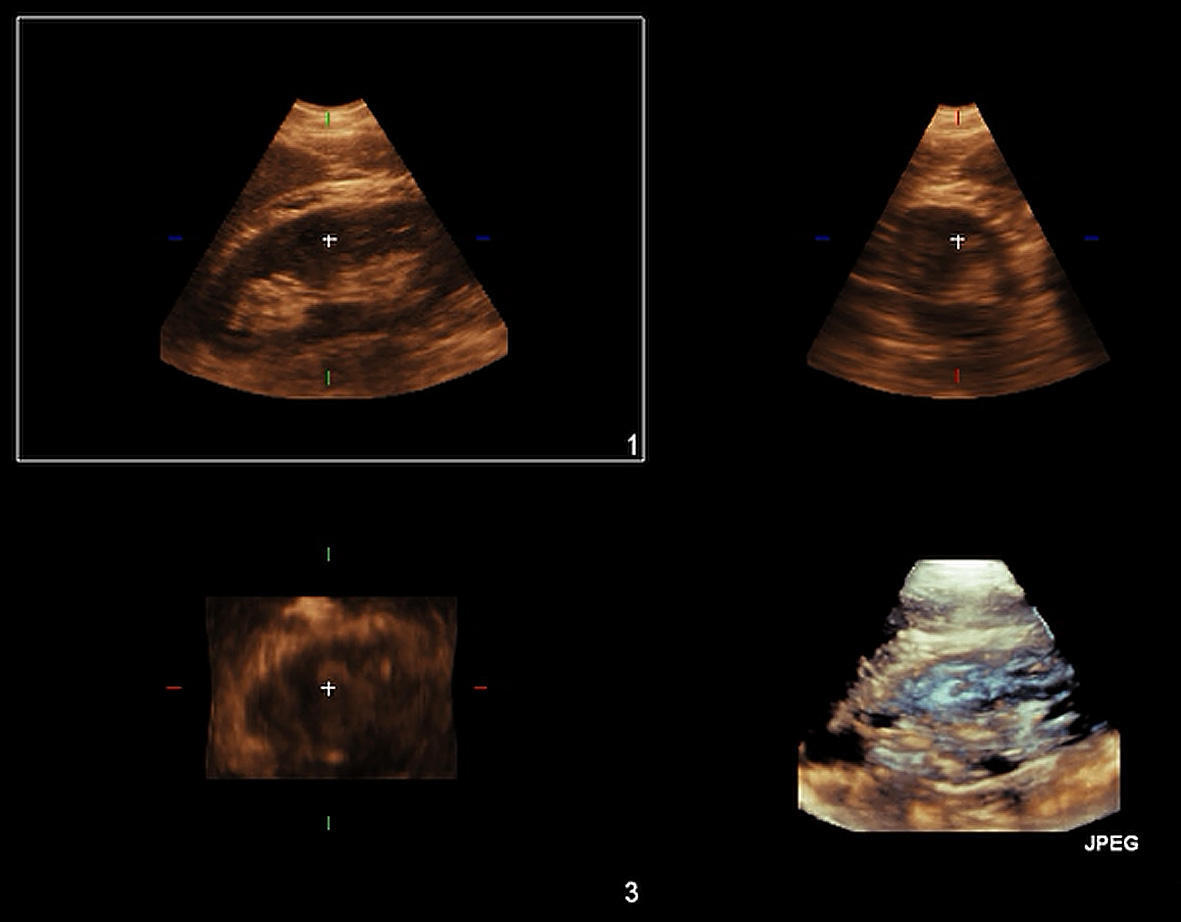 3D ultrasound image 