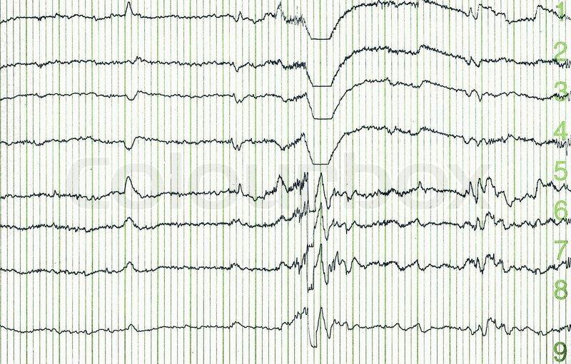 EEGtolkning hos pasienter med epilepsi Bergen Epilepsy Research