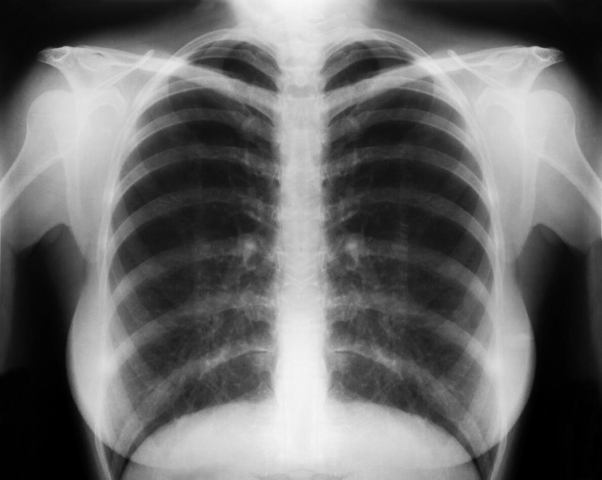X ray of lungs