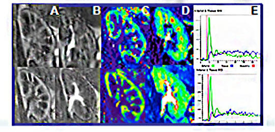 DCE-MRI time series showing images at peak and late contrast enhancement, plasma volume map and signal-time-course.