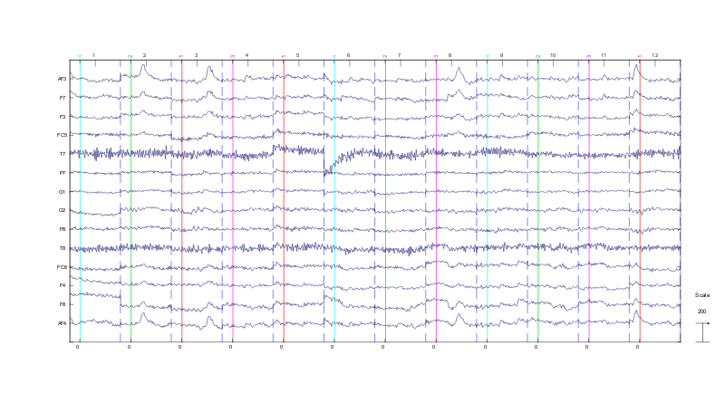 EEG hjernebølger bilde