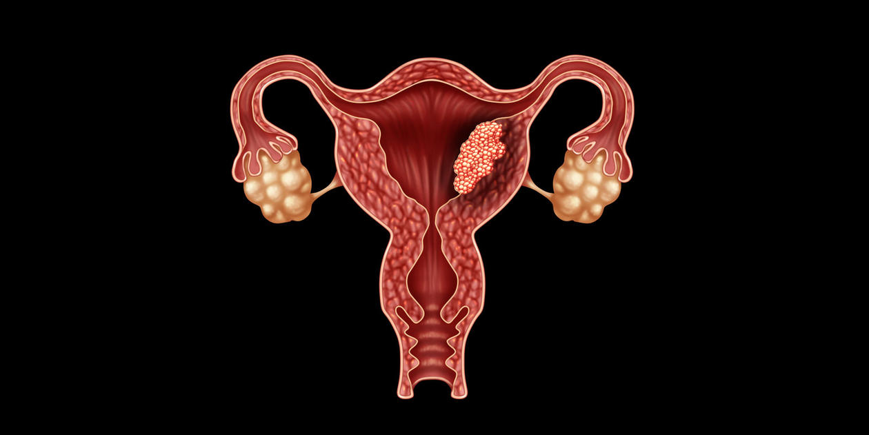 Endometrial cancer with cancerous cells in a female body attacking the reproductive system, cervical tumor