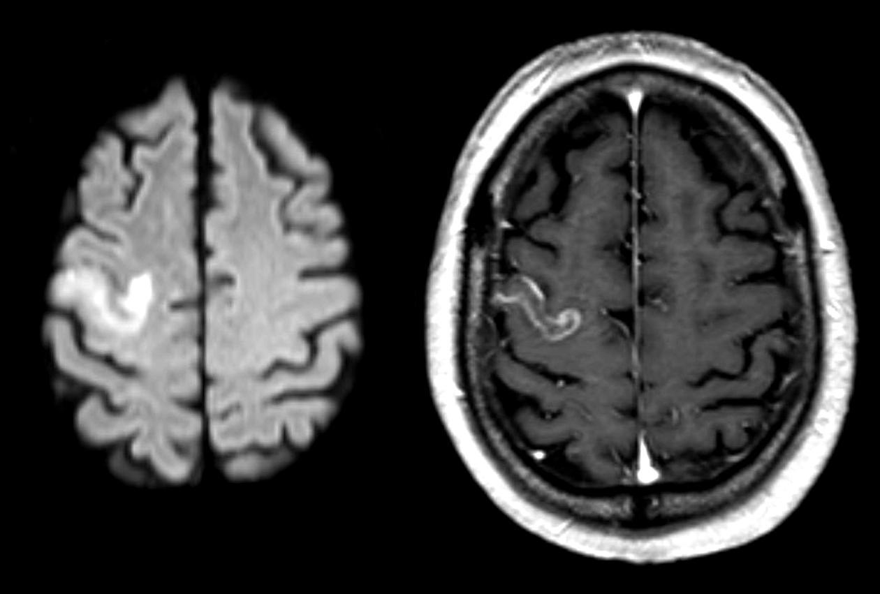 fMRI scan of a brain, used as part of an article about treatment for patients who have suffered a stroke.