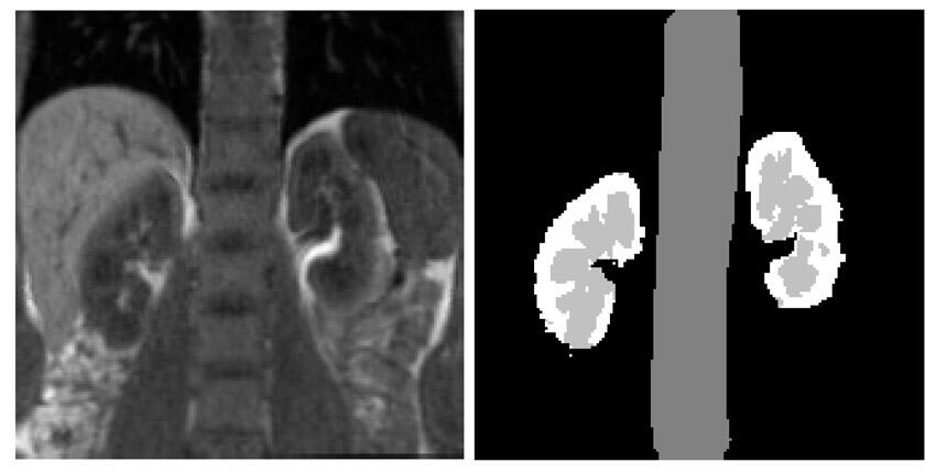 Segmentation of MRI data for computational assessment and parameter estimation related to kidneys