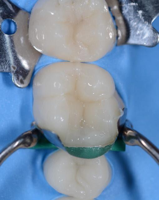 Kariologi komposittfylling tann hos UiB