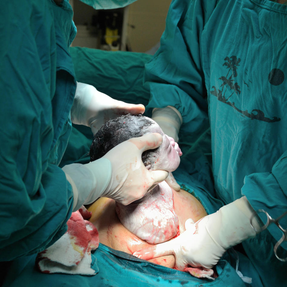 Being born by Caesarian section may affect your intelligence, Faculty of  Medicine