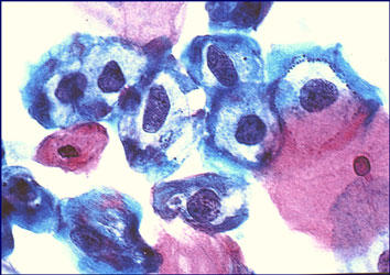 This picture shows early HPV-infected cells, so-called koilocytic cells, in a Pap-smear from the uterine cervix. 
