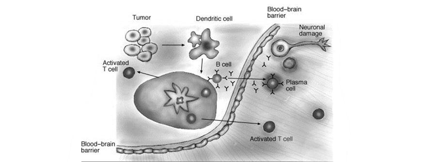 Fig 1: Proposed mechanism for PNS: A tumour expresses onconeural antigens. Dendritic cells engulf apoptotic tumour cells and migrate to the lymph node where tumour antigens are presented to the immune system with subsequent activation of B- and T-cells. A