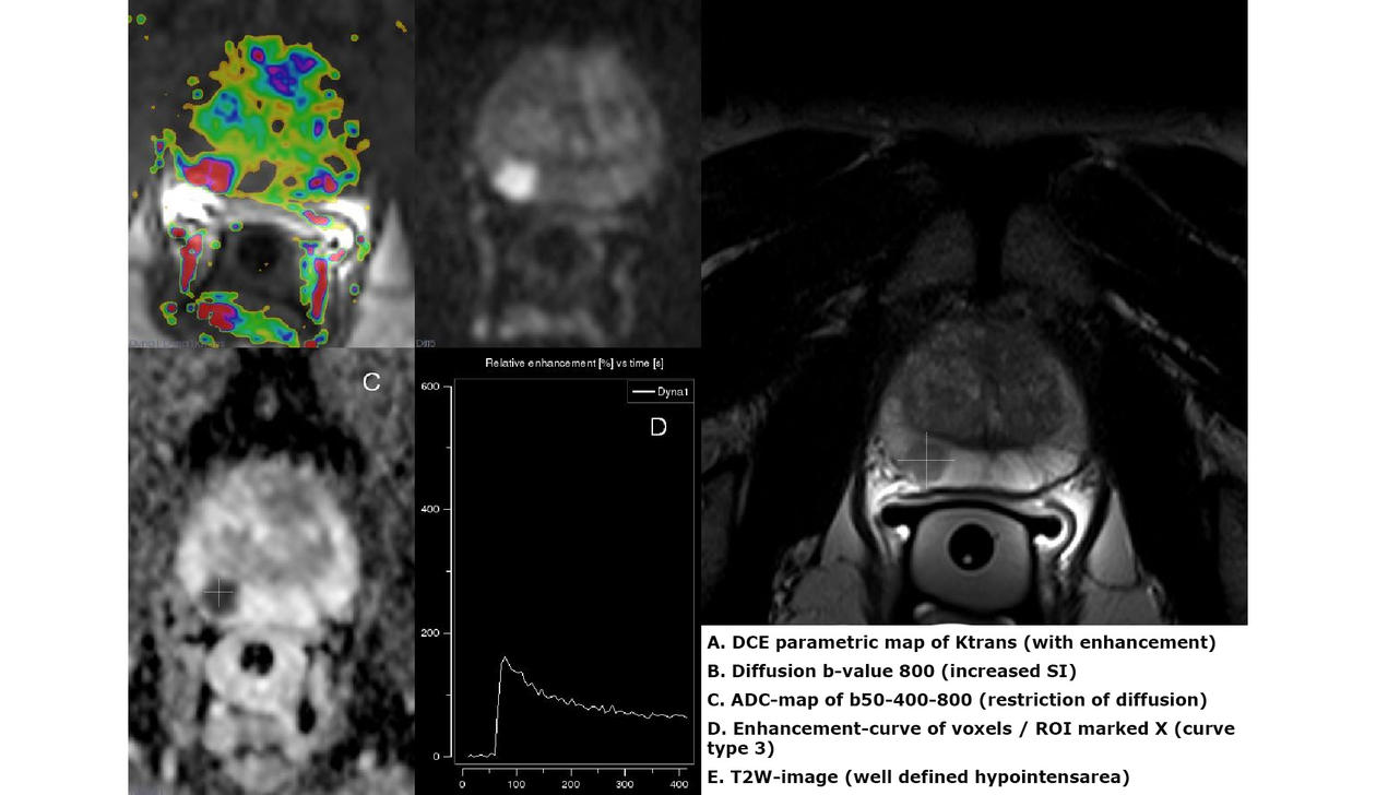Multiparametric Magnetic Resonance Imaging (mpMRI) showing a tumor in the  right peripheral zone of the prostate gland.