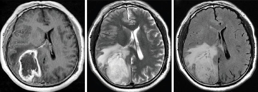 The image series shows different MRI pictures of a patient diagnosed with an astrocytoma located in the left hemisphere.