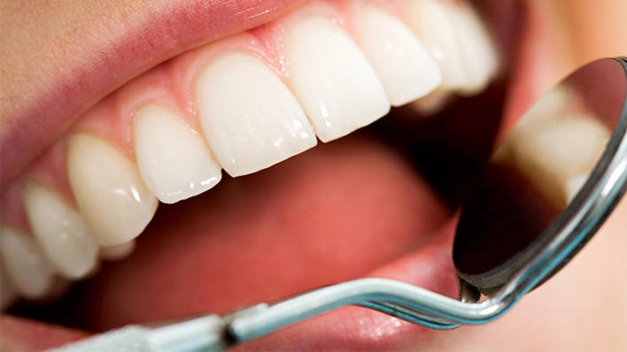 Tannproblem: Dårleg spyttproduksjon og munntørrhet som følgje av kronisk betennelse i spyttkjertlane, gjer at mange som lir av Sjögrens syndrom kan få problem med tannhelsa.