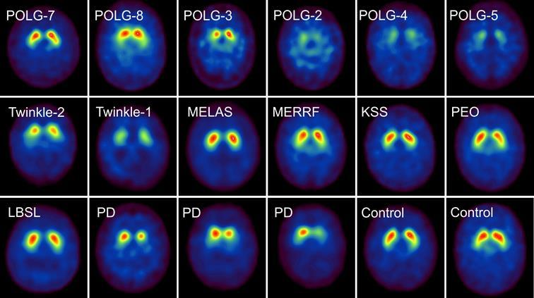Figure 2. Comparison of DAT scans from patients with mitochondrial diseases, Parkinson’s disease and controls.