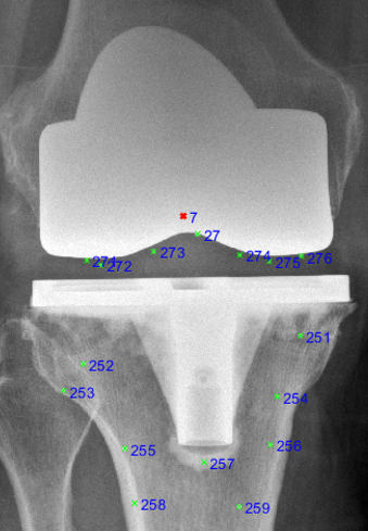 RSA X-ray of a Persona TKA