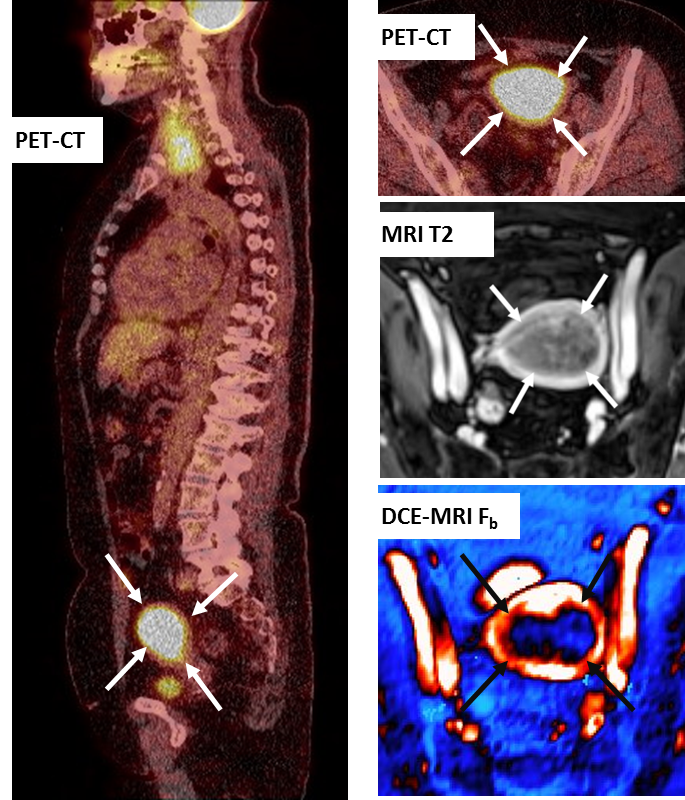 Preoperativ F18FDG PET-CT og MRI i en pasient med endometriekreft (piler). PET-CT kombinerer anatomisk informasjon (CT) med metabolsk informasjon (PET), og tumor i endometriet har typisk høyere metabolsk aktivitet sammenlignet med omkringliggende vev.  