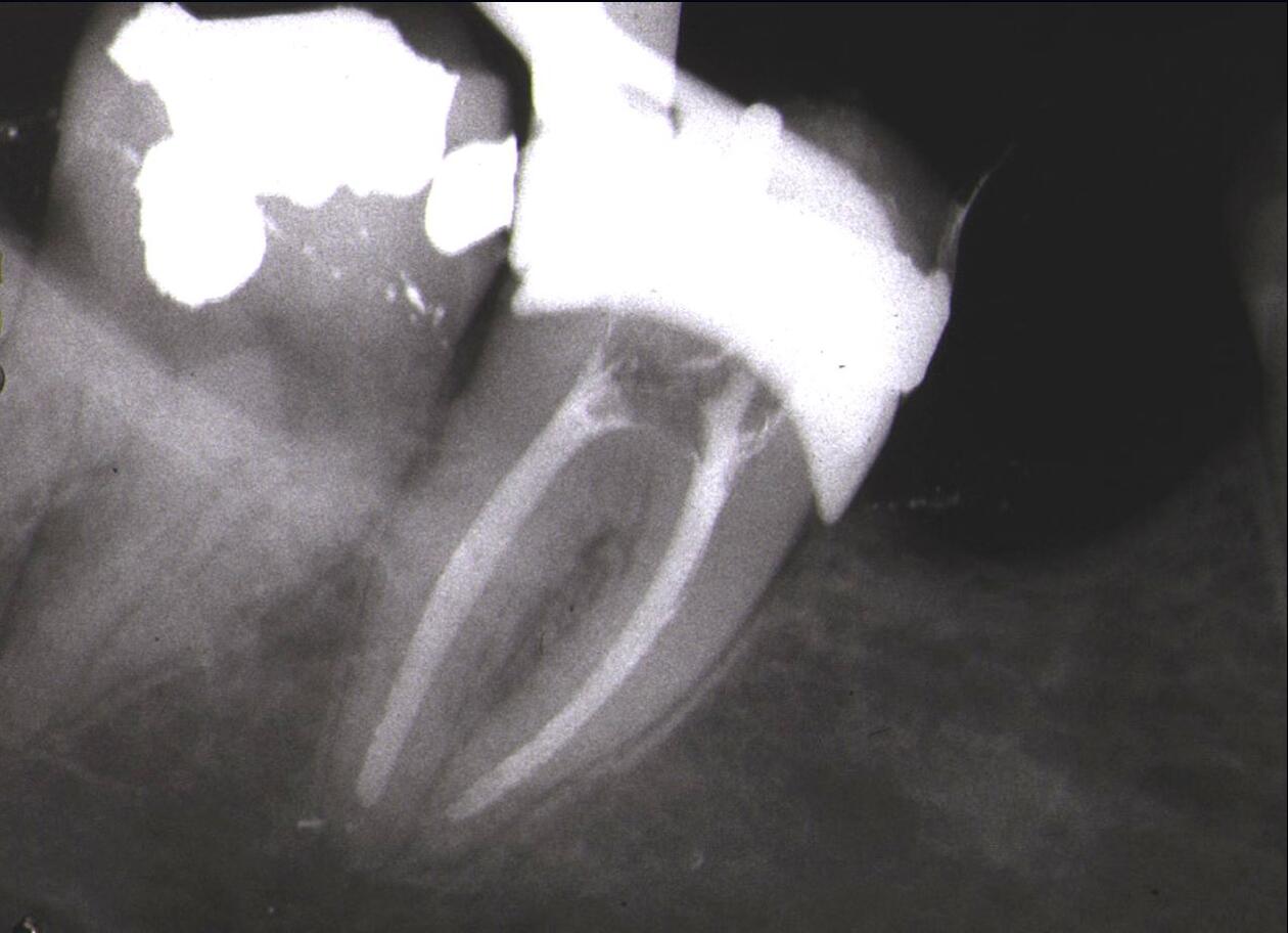 Rotbehandling hos Institutt for Klinisk odontologi