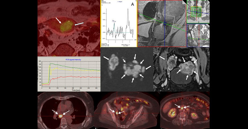 Functional imaging by MRI and PET-CT in patients with uterine cancer.
