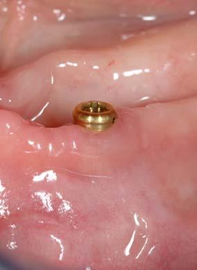 Oral implant to retain a denture