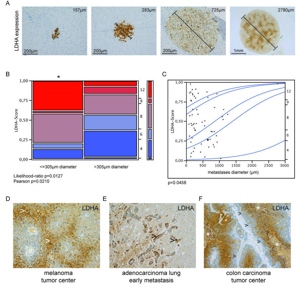 Fig. 2. LDHA expression in brain metastases. A. Different sized brain...