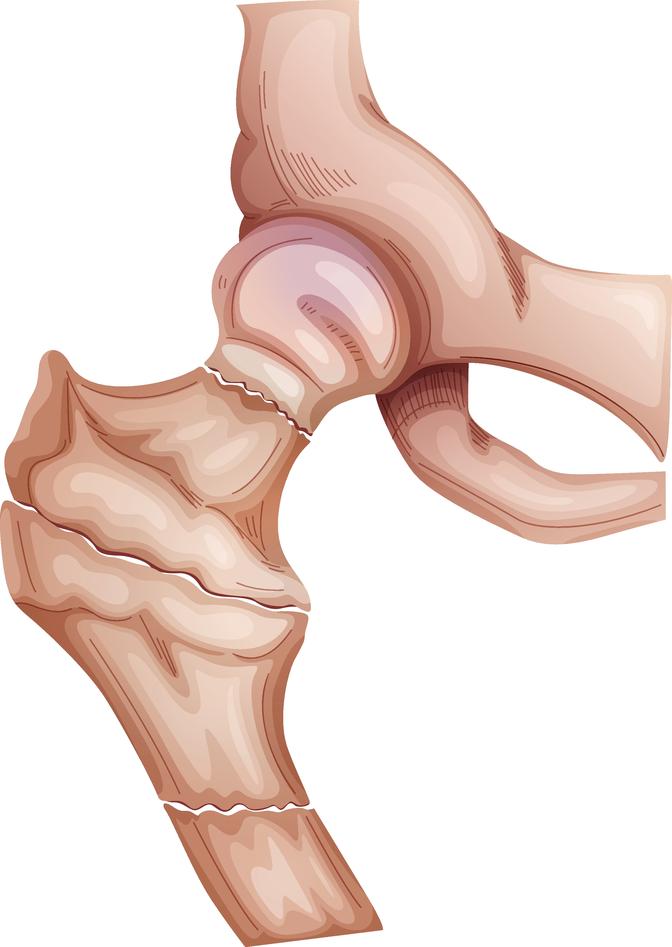 Illustration of hip fractures.