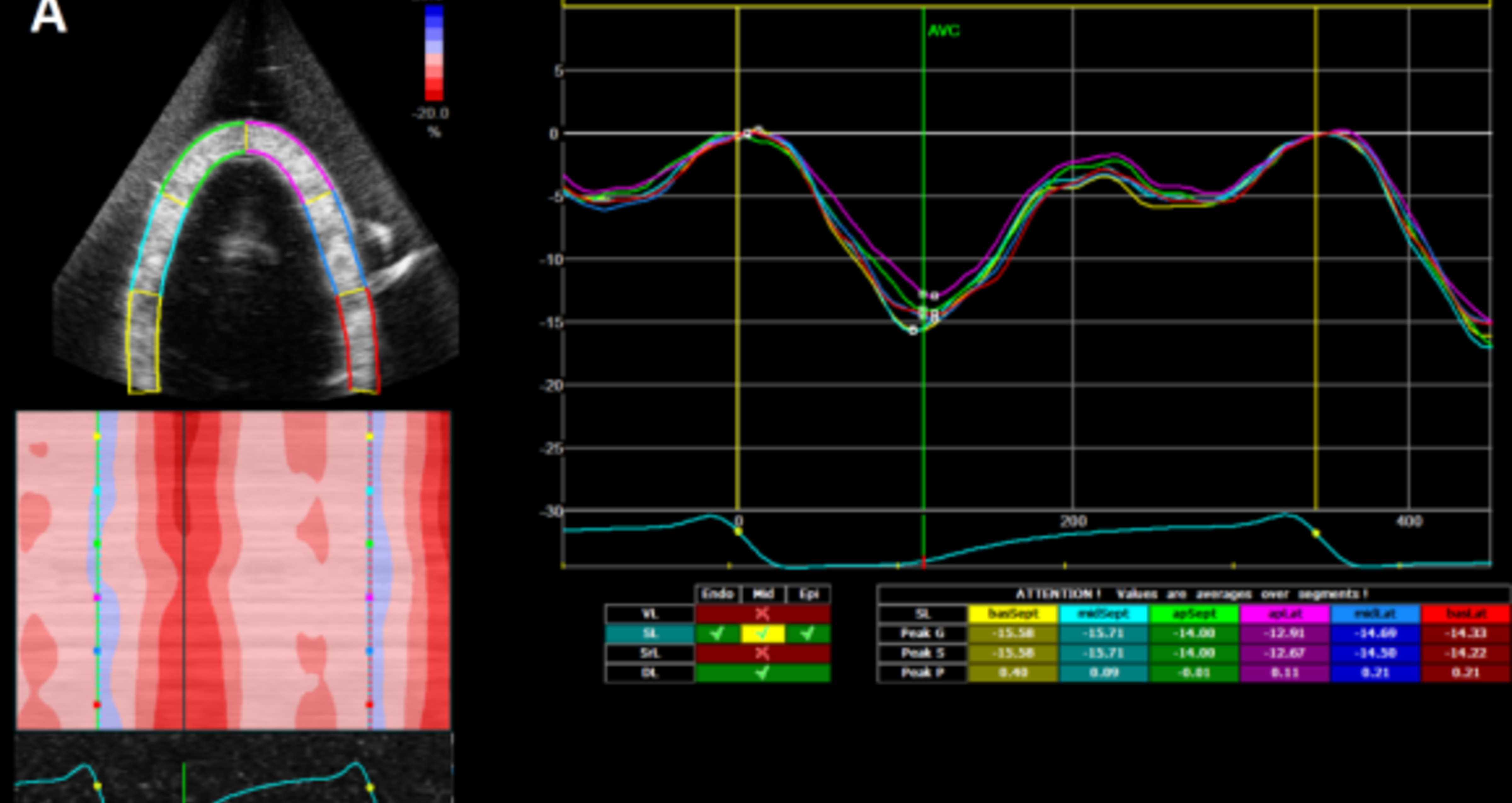 Strain målinger i en venstre hjertekammer-modell med dimensjoner som en nyfødt