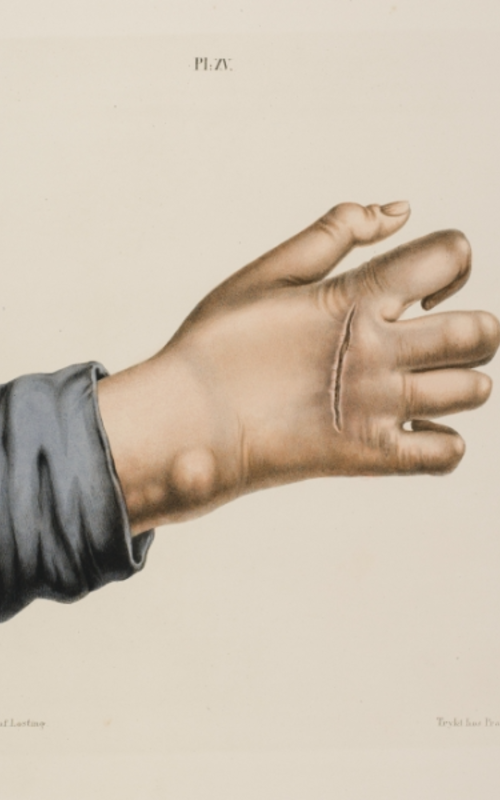 bilde av leprasyk hånd