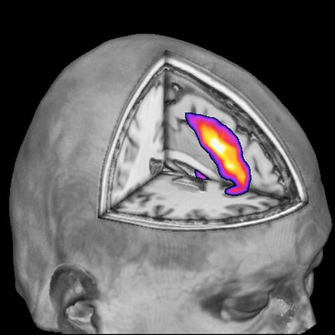 STYRER HANDLINGER: Midt i frontallappen finnes et område som er spesielt...