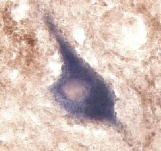 COX negative neuron from a patient with Alpers' disease