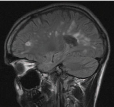 MRI picture of MS-lesions