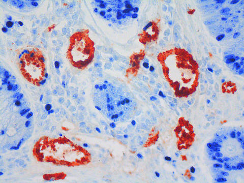 Bildet viser en kreftsvulst (kreftceller i blått) som har etablert et aktivt...