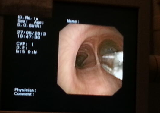 Soppmiljø i lungene