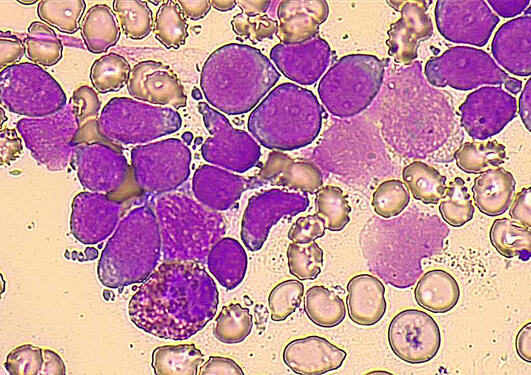 Microscopy image of AML cells.