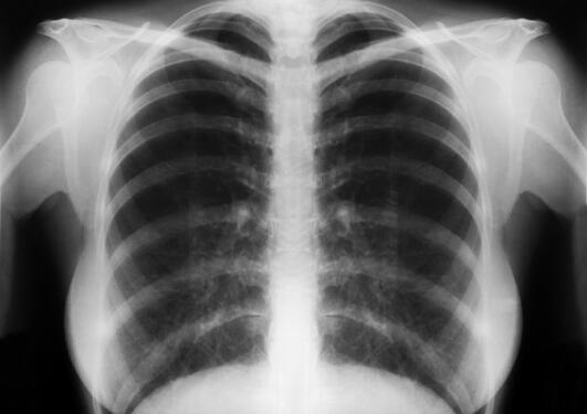 X ray of lungs