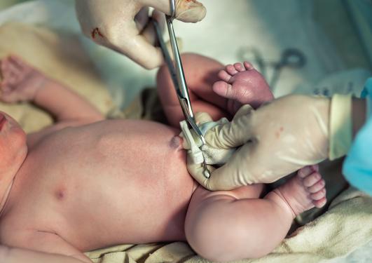 Bilde av nyfødt baby der en lege klipper navlestrengen