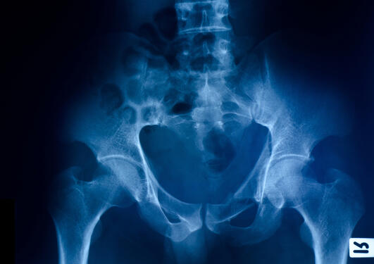 hip fracture