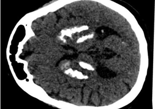 Bildet viser en CT scan av en person med hjerneforkalkning