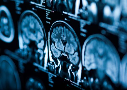 Røntgenbilde av hjerne