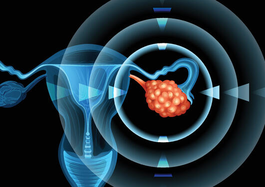 Vector showing an ovarian cancer tumor