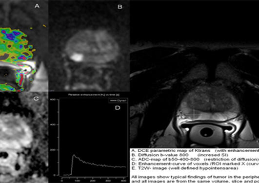 MR opptak av prostata, som alle viser typiske tumorforandringer i den perifere sonen