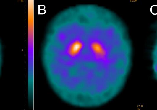 Dopamine transporter (DAT) imaging shows the uptake of a radioactive tracer...