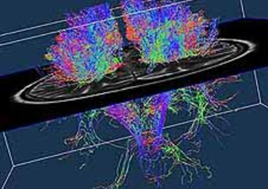 Bildet viser en synliggjøring av nervefibrer i hjernen, målt med DTI fra MR...