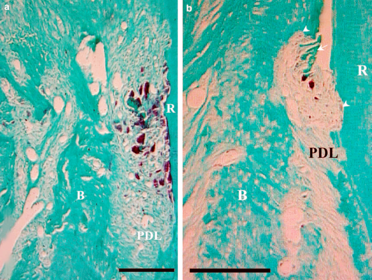 Orthodontically induced root and alveolar bone resorption Inhibitory